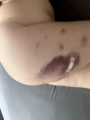 I have major bruises from a crazy caning/cnc session with one of my boyfriends 😍😍😍 hot right?